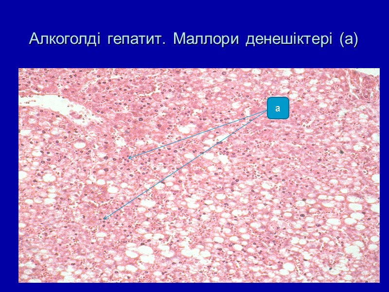 Алкоголді гепатит. Маллори денешіктері (а) а